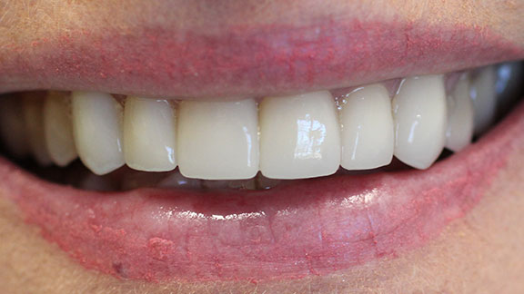 porcelain veneers after treatment