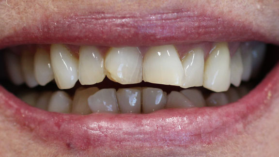 porcelain veneers before treatment