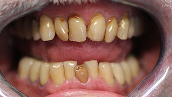 Porcelain Crowns Before